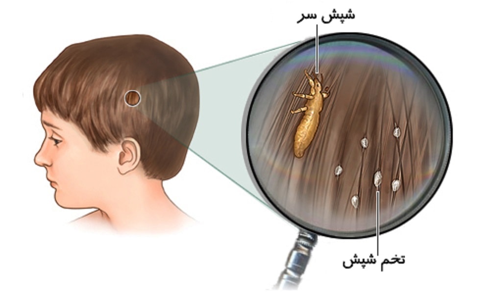 درمان هاي خانگی شپش سر