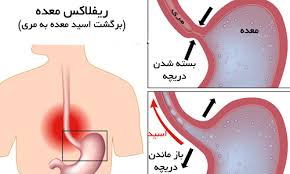 راه‌های درمان ترش کردن معده