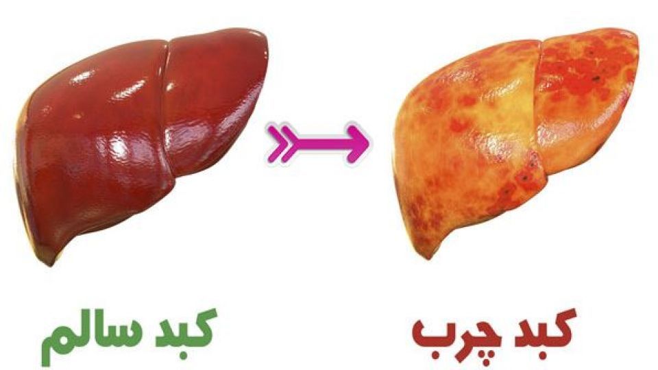 کبد چرب را از رنگ ادرار و مدفوع تشخیص دهید