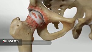 خود کفایی ایران در تولید پروتز لگن و زانو